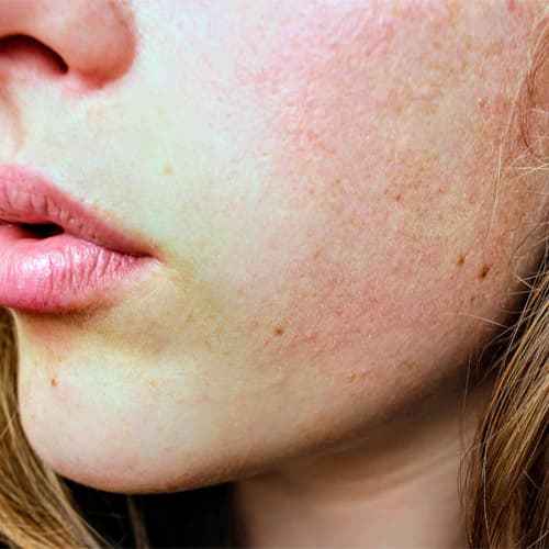 Sensitive Skin