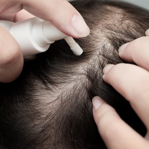 Hair Loss Issues